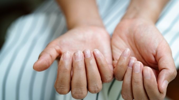 Brittle damaged nails