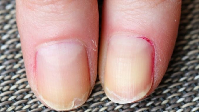 Splitting and peeling nails