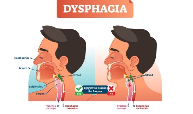 Esophageal Dysmotility: dysphagia