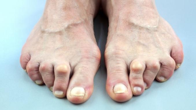 feet-deformed-rheumatoid-arthritis
