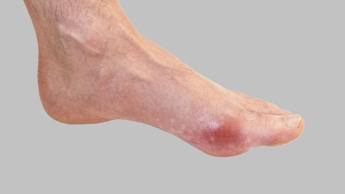 rheumatism-gout-red-leg