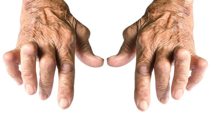 rheumatoid-arthritis-old-hands