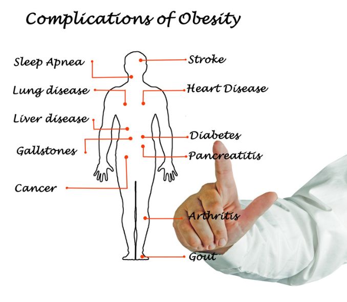 Complications of Obesity