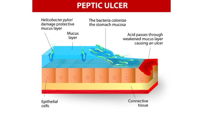 helicobacter-pylori-ulcers